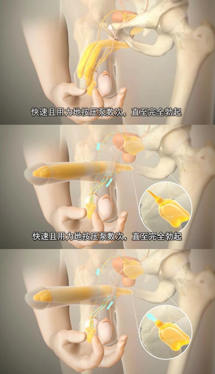 (使用方法示意图)"为爱鼓掌"前,只需用手捏一捏隐藏在阴囊的开关,假体