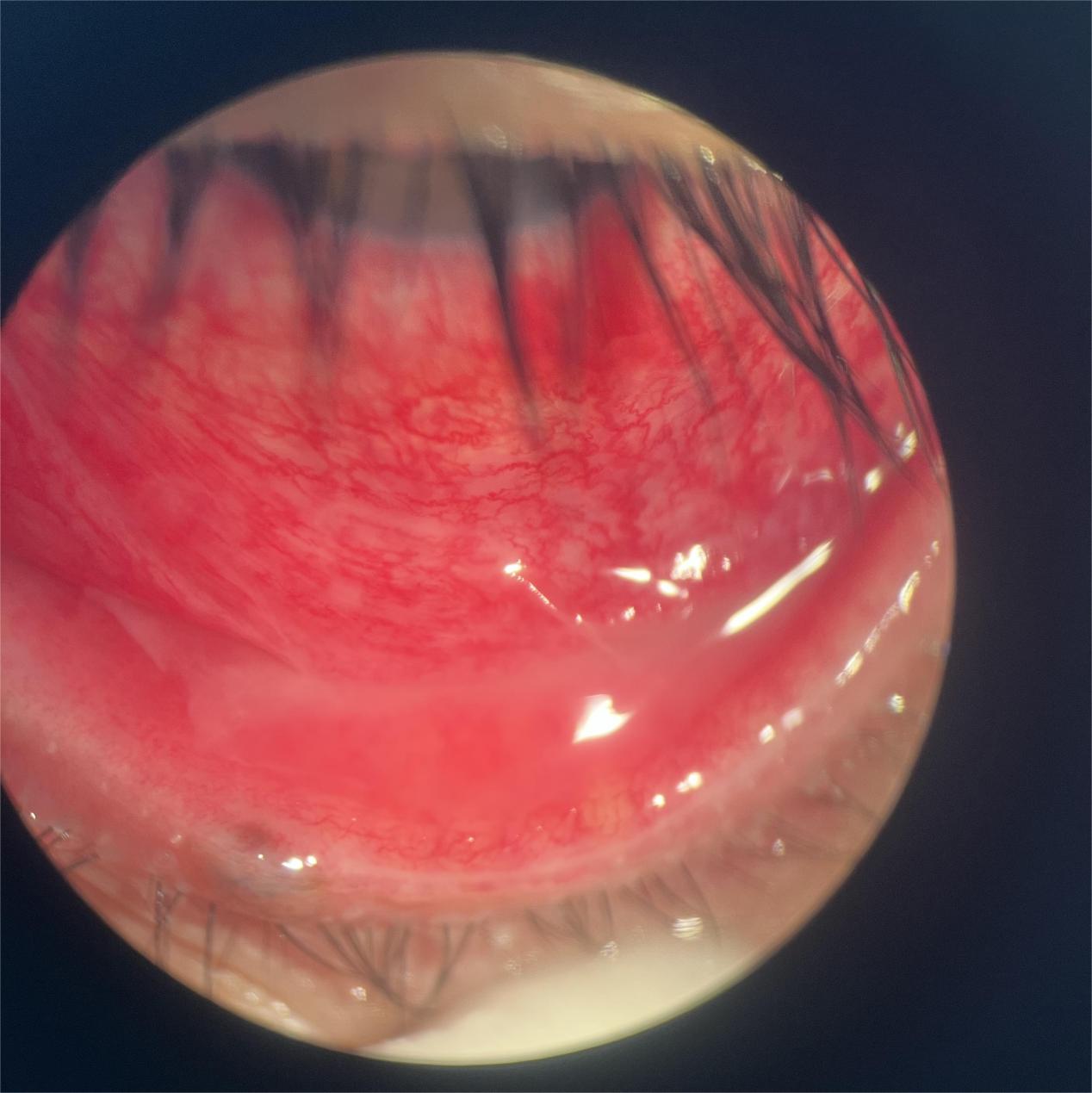 (左眼角膜中央上皮脱落(荧光染色),结膜面可见伪膜)抵御外界细菌,病毒